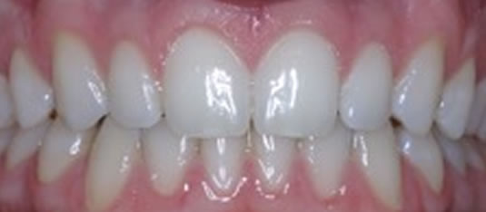 Lingual Braces: How it Works, Cost, Before and After Images